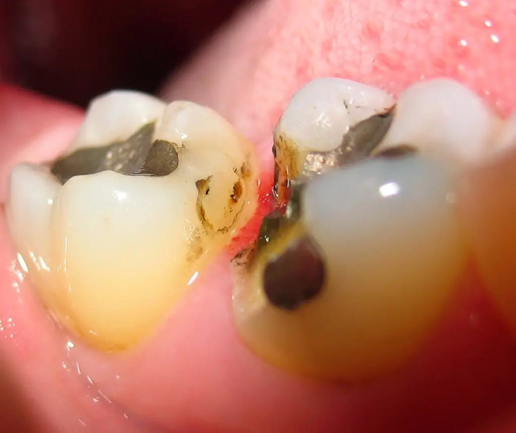 How Long Do Fillings Last? – Proteck'd Apparel